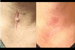 علاج الجدرة في دبي