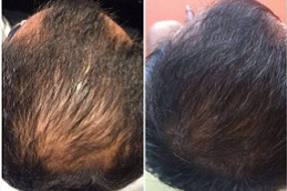 علاج ريجينيرا أكتيفا دبي