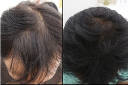 علاج ريجينيرا أكتيفا في دبي