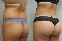 أفضل إعادة تشكيل المؤخرة الفرنسية دبي