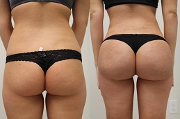 أفضل إعادة تشكيل المؤخرة الفرنسية في دبي