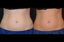 أفضل النحت البارد علاج تجميد الدهون دبي