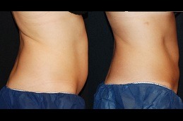 أفضل النحت البارد علاج تجميد الدهون في دبي