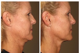 أفضل علاج شد الجلد بالليزر دبي