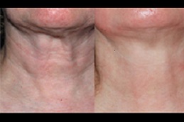 أفضل علاج شد الجلد بالليزر في دبي