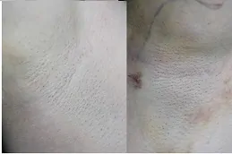 أفضل علاج فرط التعرق بالليزر في دبي