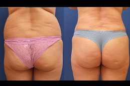 أفضل عيادة إعادة تشكيل المؤخرة الفرنسية دبي