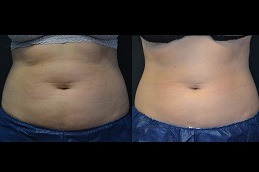 أفضل عيادة النحت البارد علاج تجميد الدهون دبي