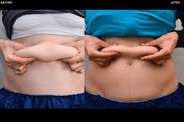 أفضل عيادة النحت البارد علاج تجميد الدهون في دبي