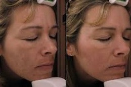 أفضل عيادة علاج الكلف في دبي