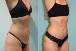 أفضل عيادة عملية شد البطن المحيطية في دبي