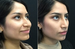 أفضل عيادة وظيفة الأنف غير الجراحية في دبي