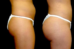 إعادة تشكيل المؤخرة الفرنسية دبي