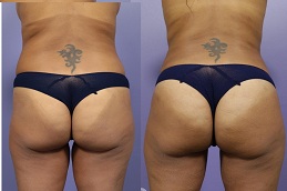 إعادة تشكيل المؤخرة الفرنسية في دبي