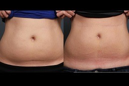 النحت البارد علاج تجميد الدهون دبي