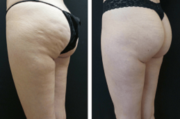 سيلفينا - علاج السيلوليت دبي