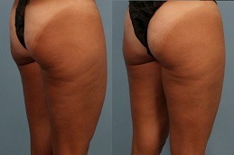 سيلفينا - علاج السيلوليت في دبي