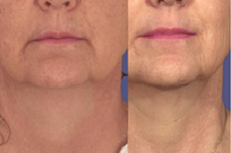 علاج شد الجلد بالليزر دبي