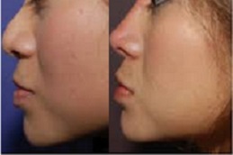 وظيفة الأنف غير الجراحية دبي