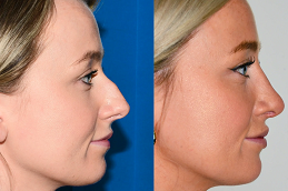 تجميل الأنف في دبي