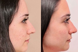 تجميل الانف