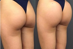 تكبير الأرداف بالفيلر في العين