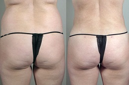 تكبير المؤخره في دبي