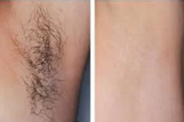 إزالة الشعر بالليزر دبي