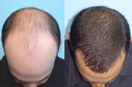 علاج تساقط الشعر بطرق آمنة وغير جراحية