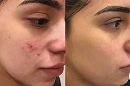 علاج ندبات حب الشباب بالطرق الطبيعية والطبية