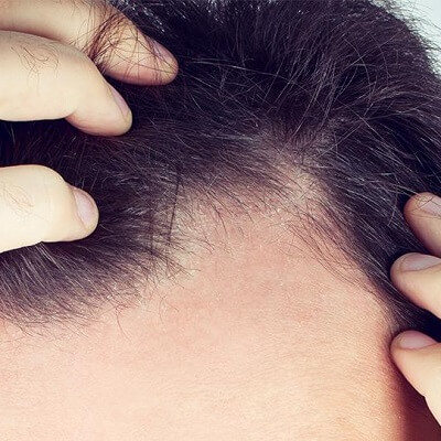 علاج تساقط الشعر في دبي وأبو ظبي - التكلفة علاج نمو الشعر في الإمارات