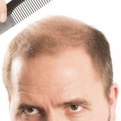 زراعة الشعر بتقنية زرع الشعر المباشر في دبي وأبو ظبي DHI