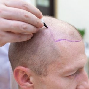 زراعة الشعر التركي في دبي