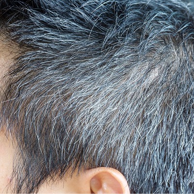 إزالة الشعر الأبيض في دبي وأبو ظبي والشارقة عيادة رويال