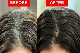 إزالة الشعر الأبيض بالليزر في دبي نتائج سريعة وآمنة