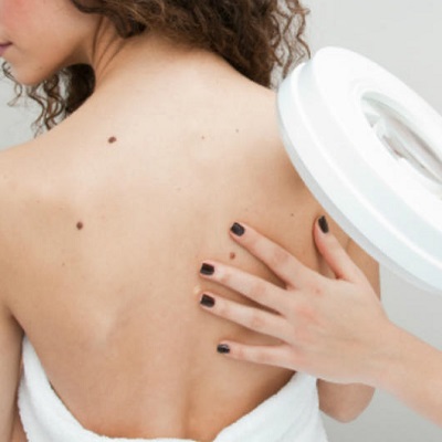 تكلفة إزالة الوحمات بالليزر في دبي وأبو ظبي والشارقة السعر