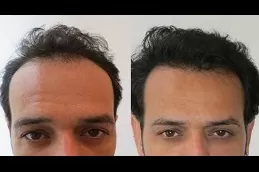 زراعة الشعر المباشر بتقنية DHI في دبي وأبو ظبي
