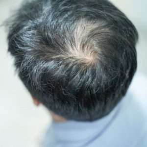 زراعة الشعر بالاقتطاف – إيجابيات وسلبيات استخلاص الوحدات المسامية