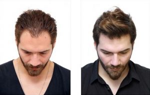 زراعة الشعر بتقنية الاقتطاف FUE في دبي وأبو ظبي