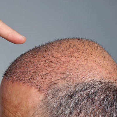زراعة الشعر بدون حلاقة في دبي وأبو ظبي والشارقة