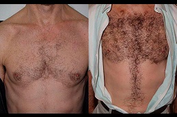 عيادة دبي لزراعة شعر الجسم