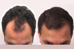 زراعة شعر دبي للذكور في دبي