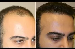 زرع الشعر المباشر DHI دبي