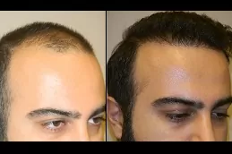 زرع الشعر المباشر DHI في دبي