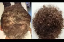 علاج تساقط الشعر بالليزر في دبي وأبو ظبي