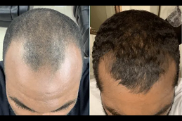 علاج تساقط الشعر في دبي