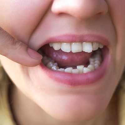 علاج الأسنان الملتوية في دبي وأبو ظبي تكلفة الأسنان الملتوية