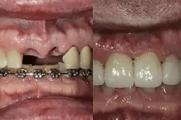 أسعار زراعة كامل الأسنان