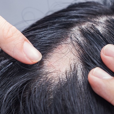 تكلفة علاج الثعلبة البقعية في دبي وأبو ظبي ثعلبة السعر