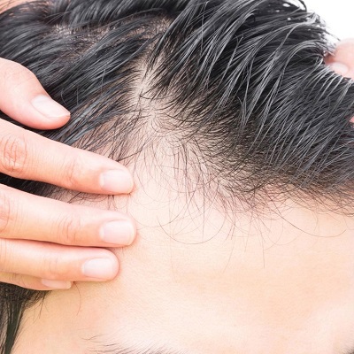 جراحة زراعة الشعر في دبي وأبو ظبي والشارقة كلفة
